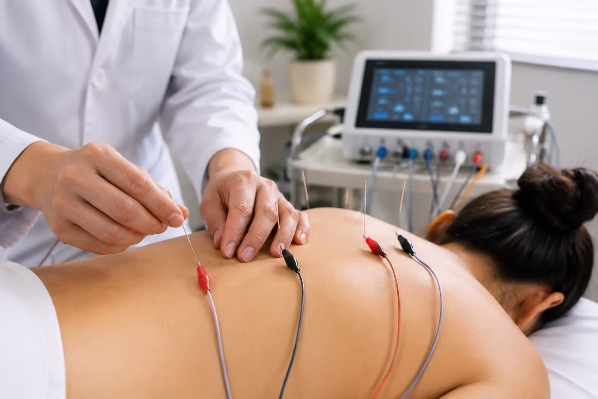 Electroacupuncture Explained: What It Is and How It Works